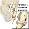 Как лечить подагру? Как лечить подагру?