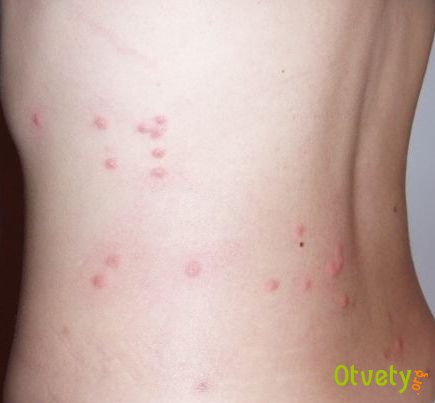 Как избавиться от укусов блох. Методы борьбы с блохами и профилактика их появления в помещении.